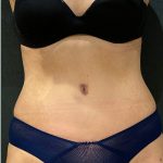 Tummy Tuck Before & After Patient #12351