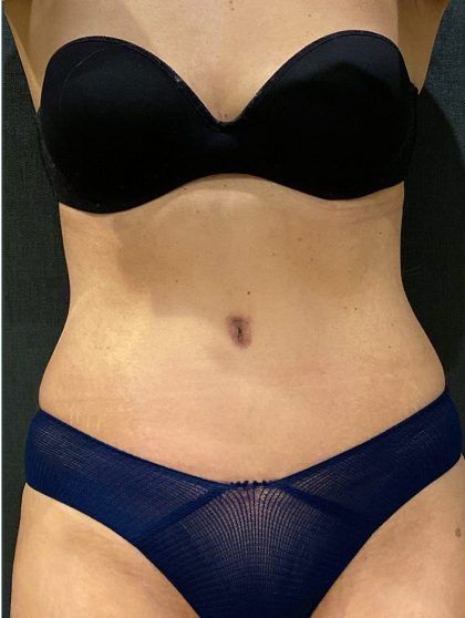 Tummy Tuck Before & After Patient #12351