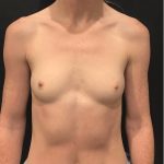 Breast Augmentation Before & After Patient #12339
