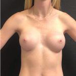 Breast Augmentation Before & After Patient #12339