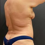 Liposuction Before & After Patient #12391