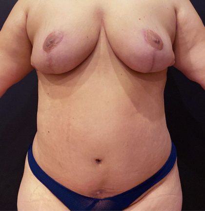 Liposuction Before & After Patient #12391