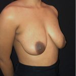 Breast Augmentation Before & After Patient #12358