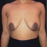 Breast Augmentation Before & After Patient #12358