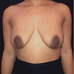 Breast Augmentation Before & After Patient #12358