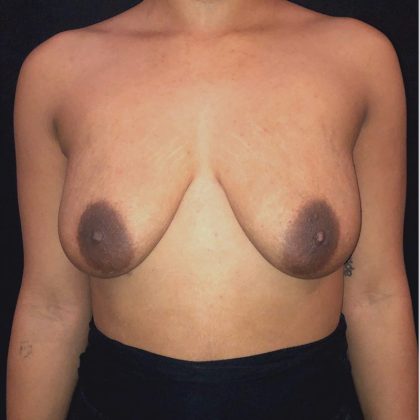 Breast Augmentation Before & After Patient #12358