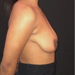 Breast Augmentation Before & After Patient #12358