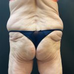 Liposuction Before & After Patient #12716