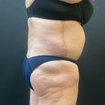 Liposuction Before & After Patient #12716