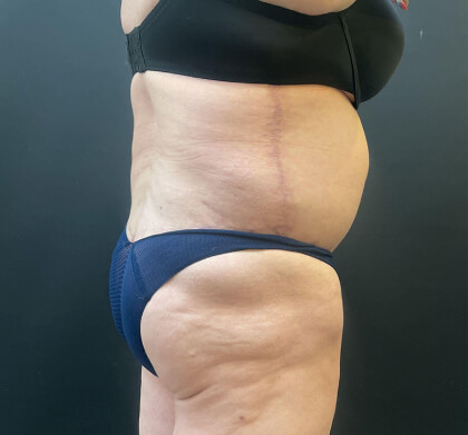 Liposuction Before & After Patient #12716