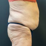 Liposuction Before & After Patient #12716