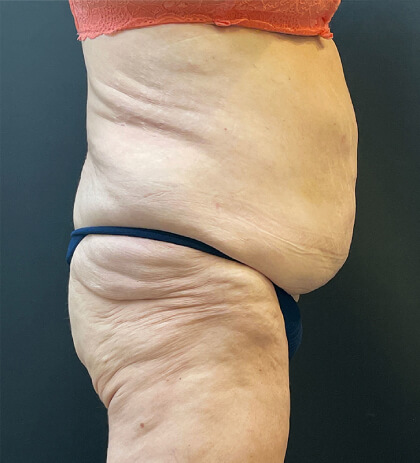 Liposuction Before & After Patient #12716