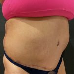 Liposuction Before & After Patient #12716