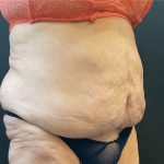 Liposuction Before & After Patient #12716