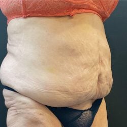 Liposuction Before & After Patient #12716
